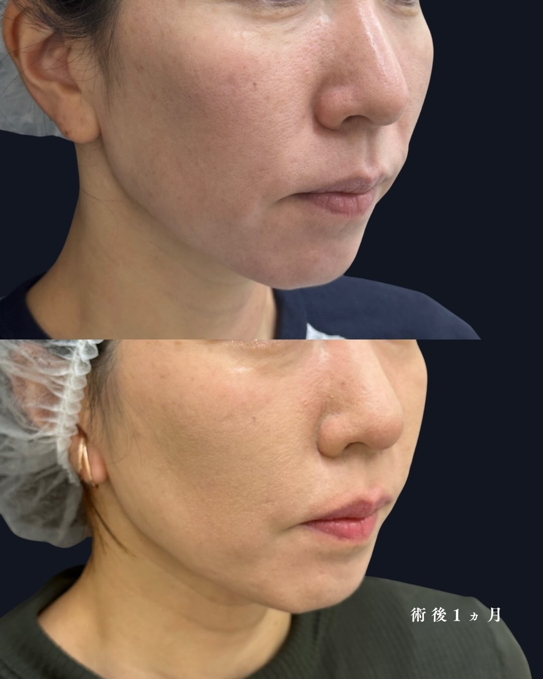 ヒアルロン酸注入