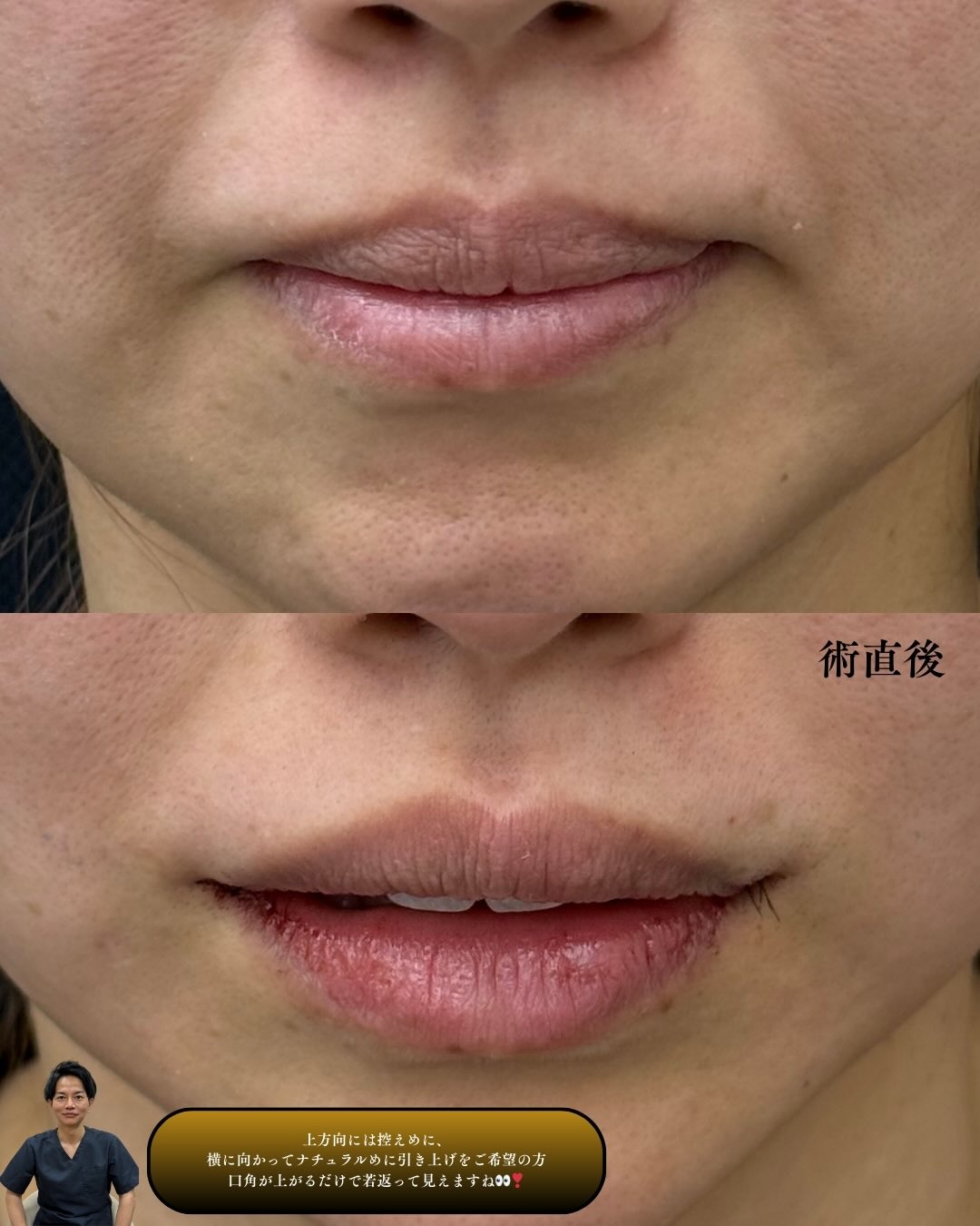 口角拳上症例2