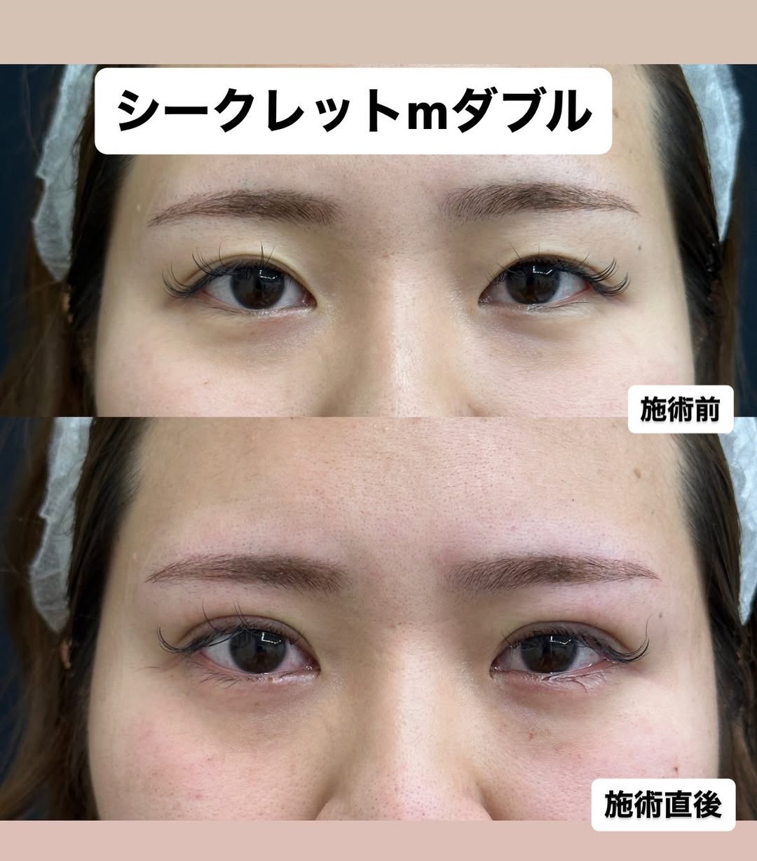 持続性が高い埋没法のメイン画像