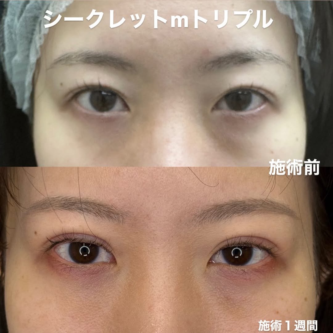 埋没法シークレットMトリプル 術後1週間のメイン画像