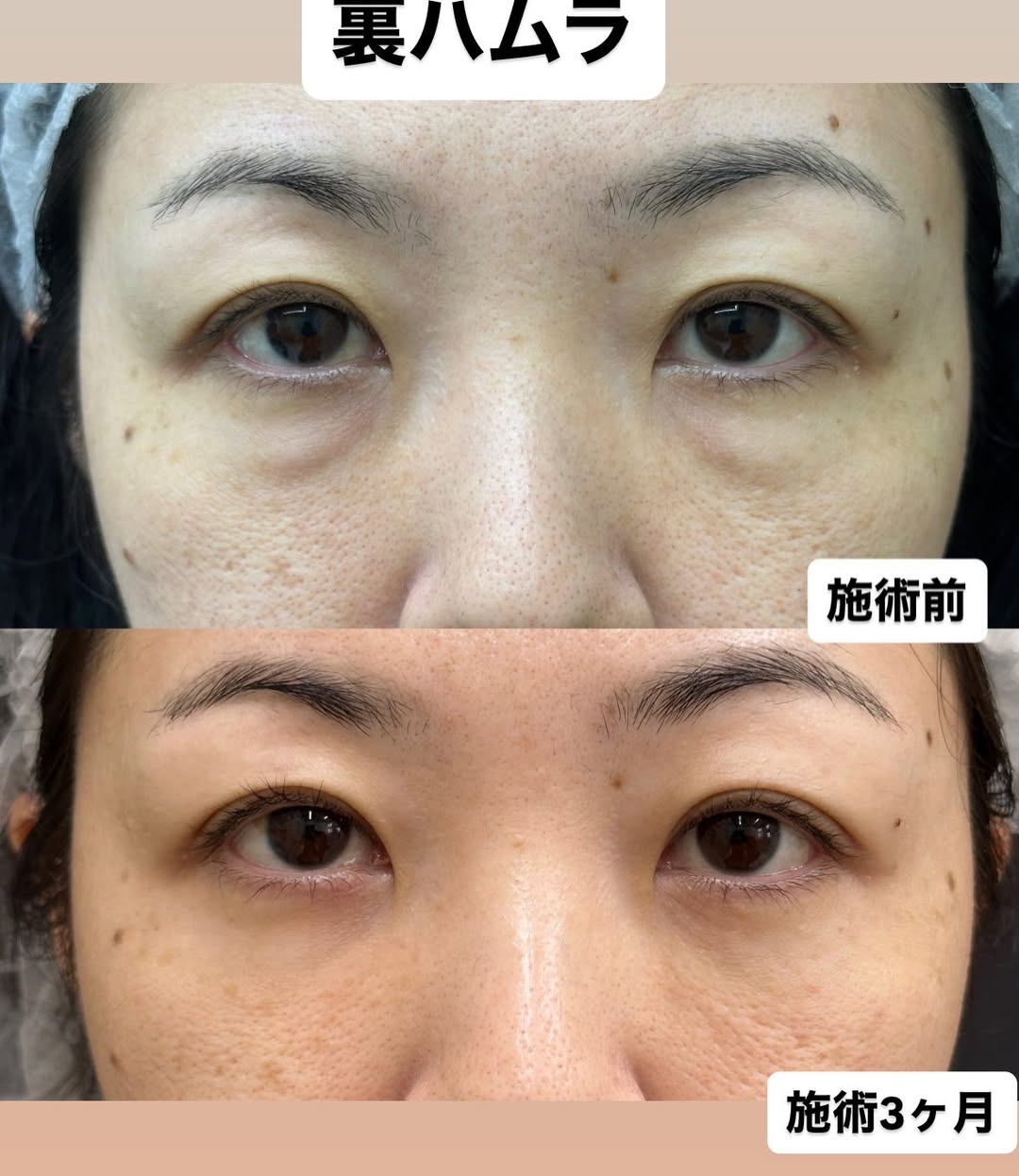 若返り！裏ハムラ法施術3ヶ月の症例のメイン画像