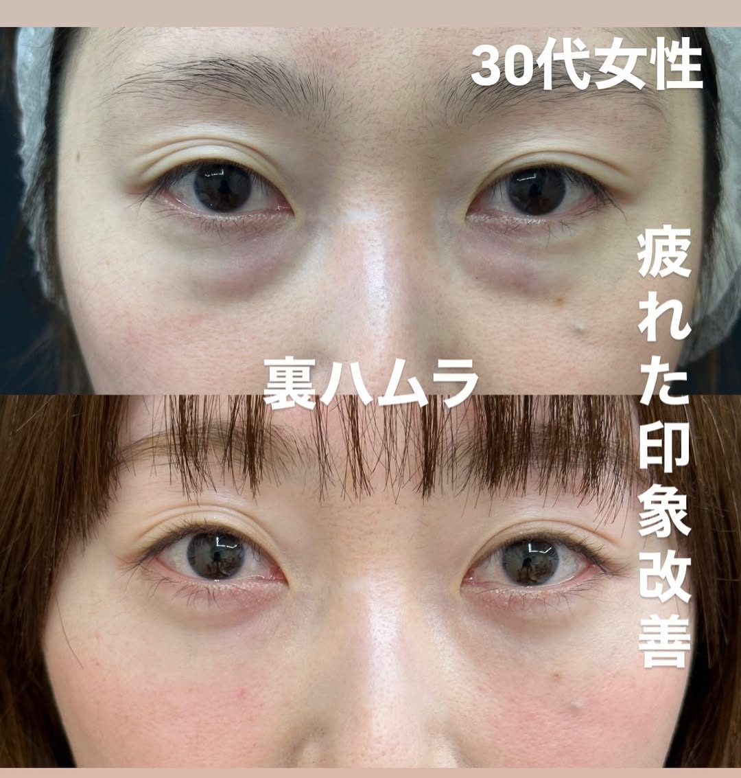 裏ハムラ法でクマを隠すコンシーラーが不要に！のメイン画像