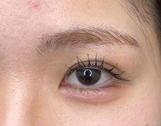 持続性の高い埋没法：シークレットMトリプルのメイン画像