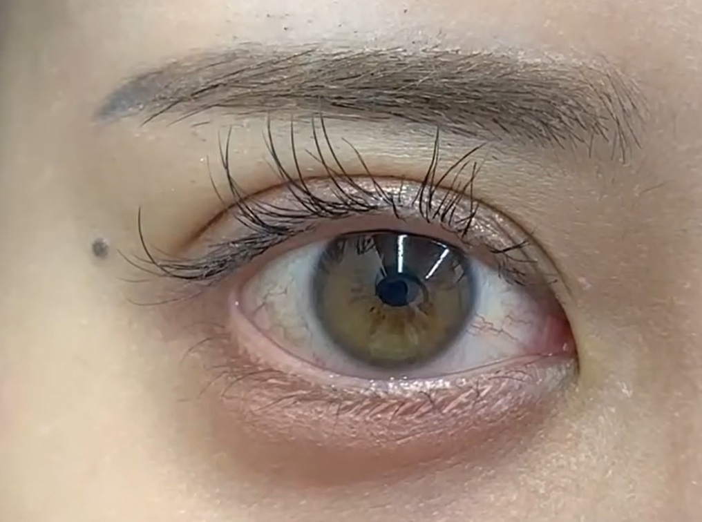 抜糸～埋没法のメイン画像