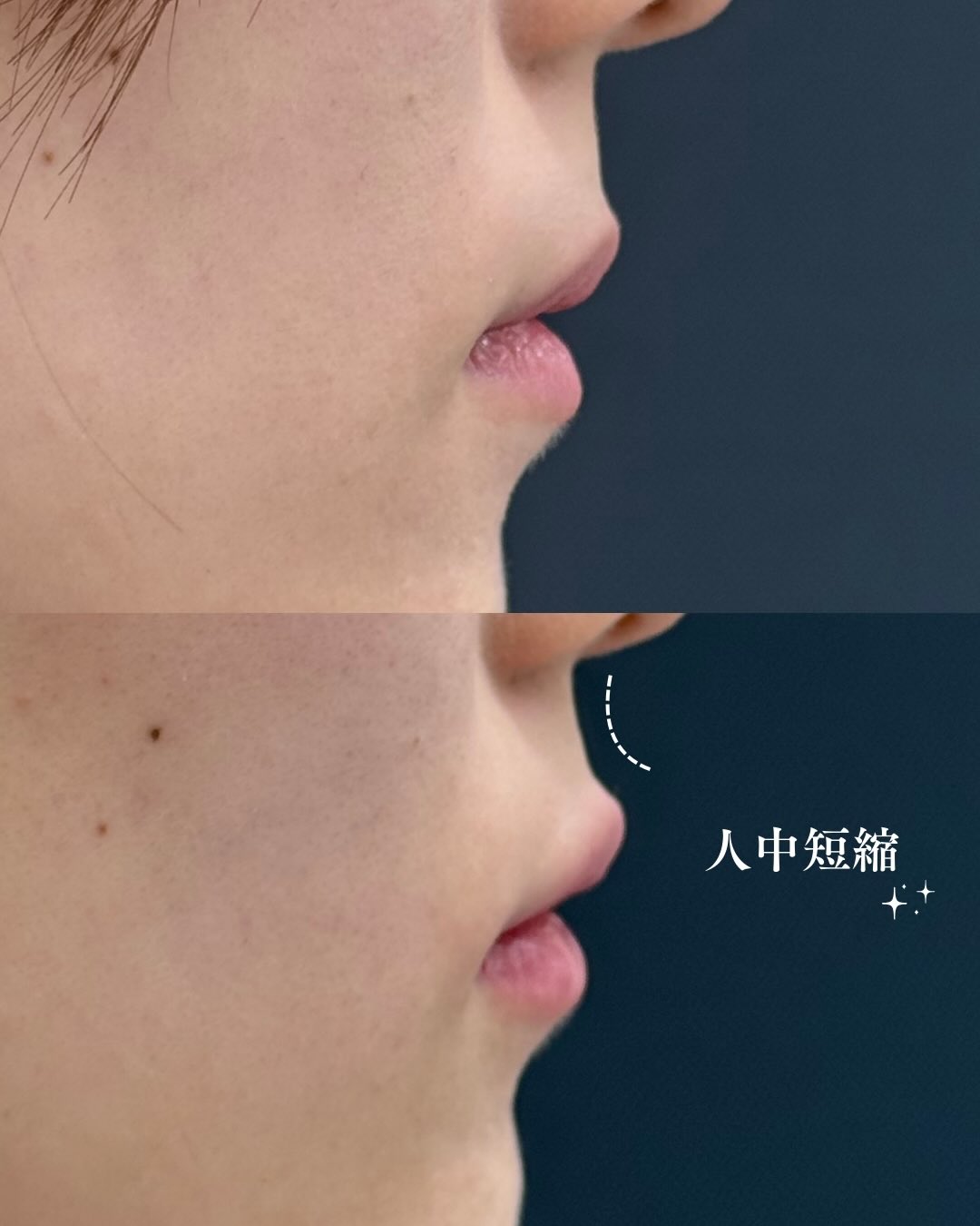 ヒアルロン酸注入症例