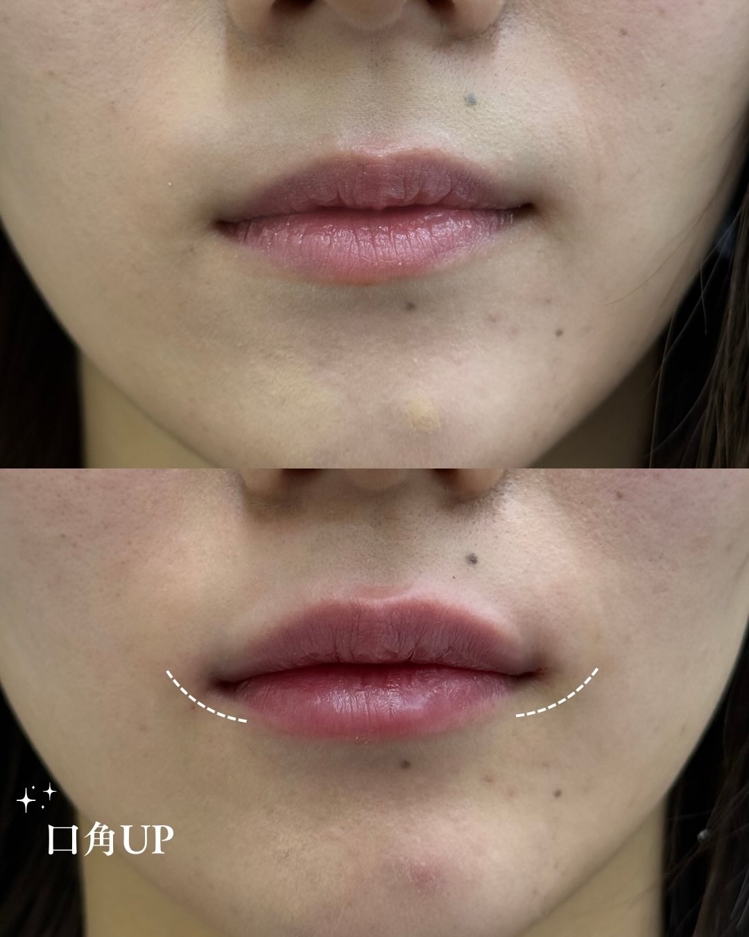 ヒアルロン酸注入