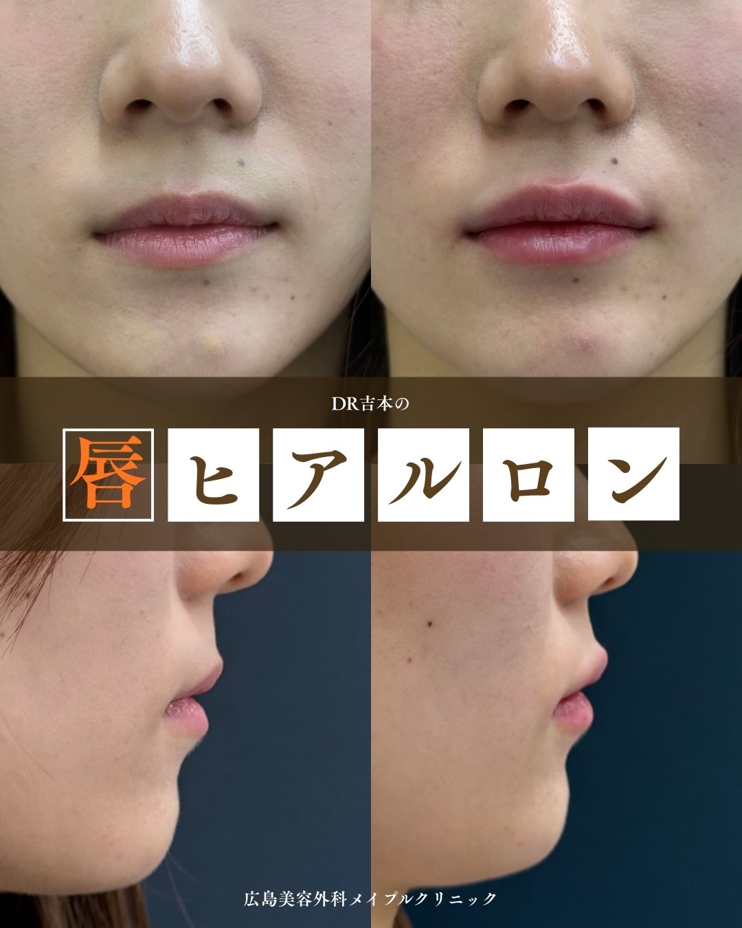 人気の唇ヒアルロン酸のメイン画像