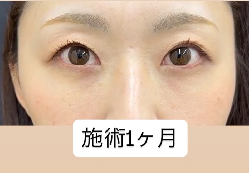 裏ハムラ法で若返りのメイン画像