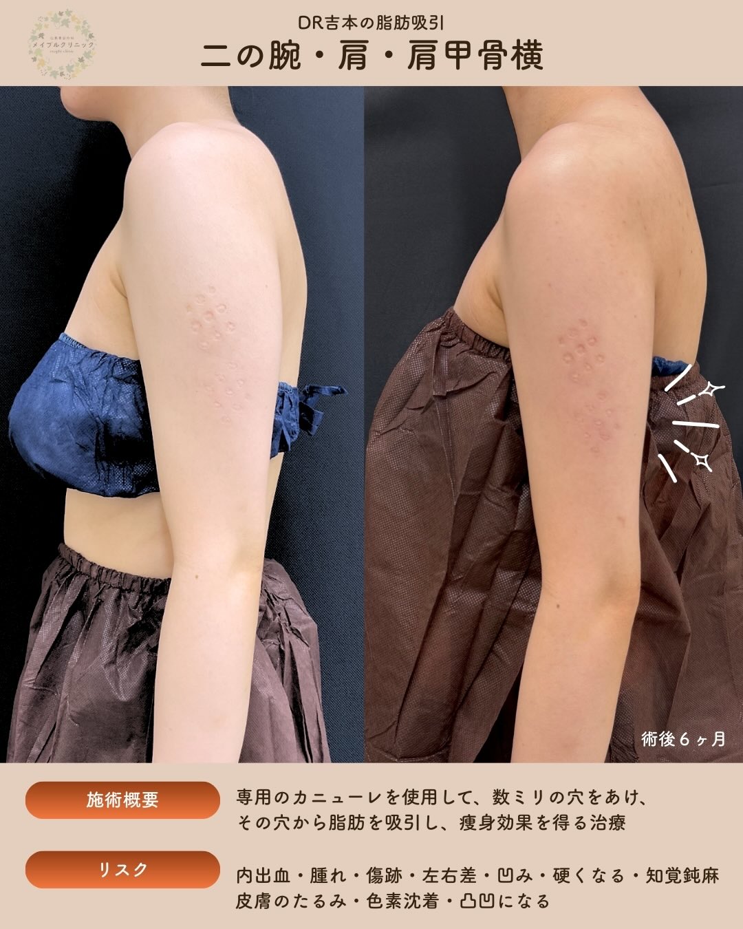 ボコつかない！なめらかラインの脂肪吸引のメイン画像