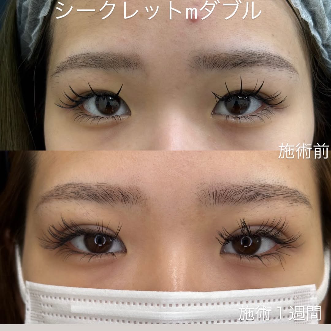埋没法でナチュラルな二重にのメイン画像