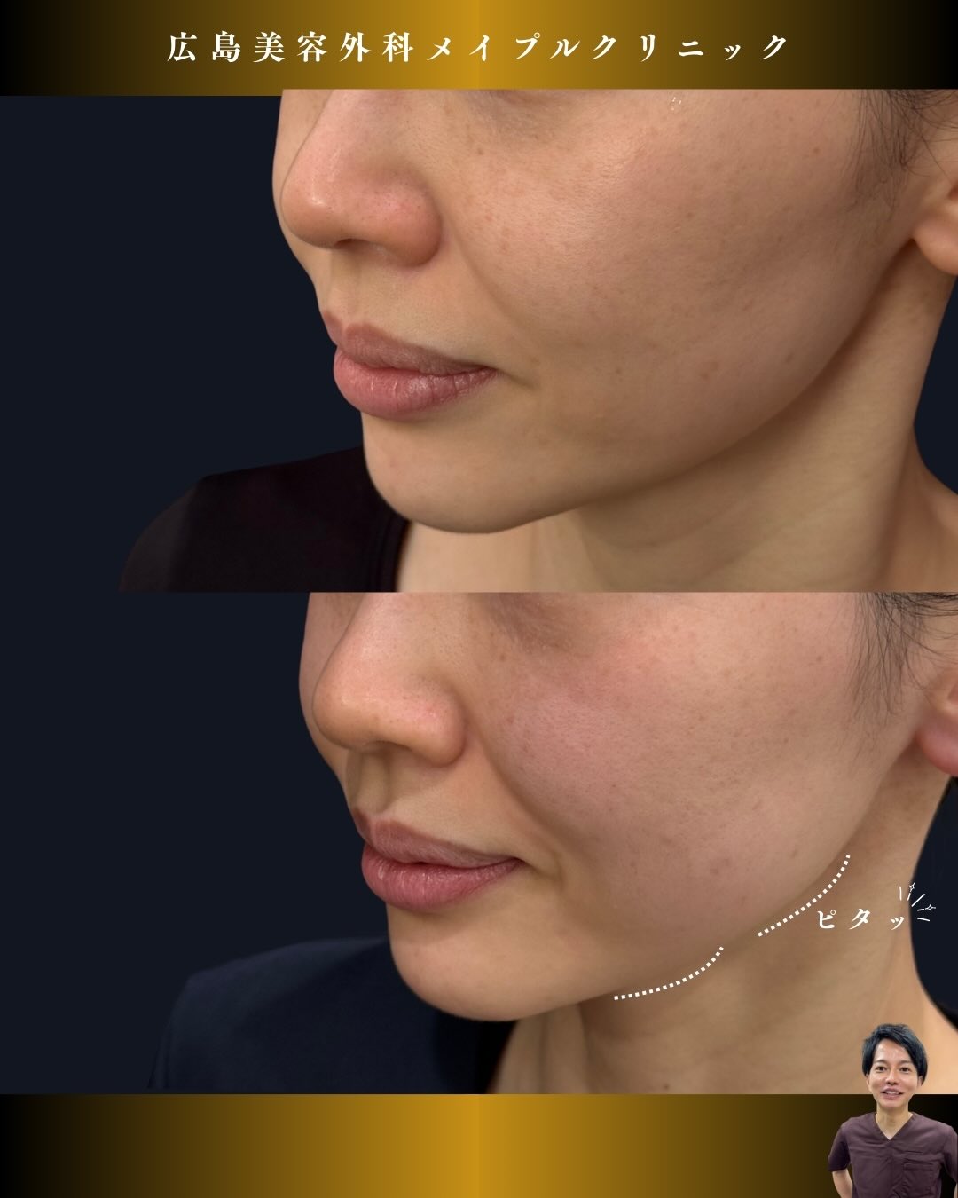 スーパーハイフ