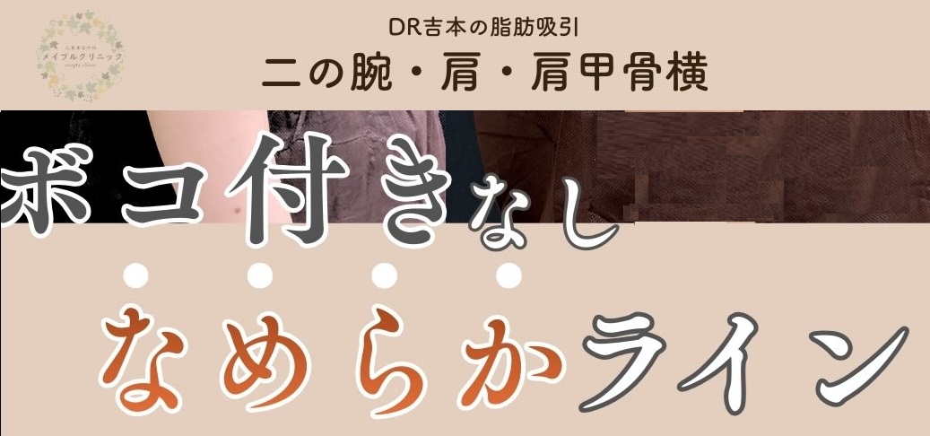 ボコつかない！なめらかラインの脂肪吸引のメイン画像