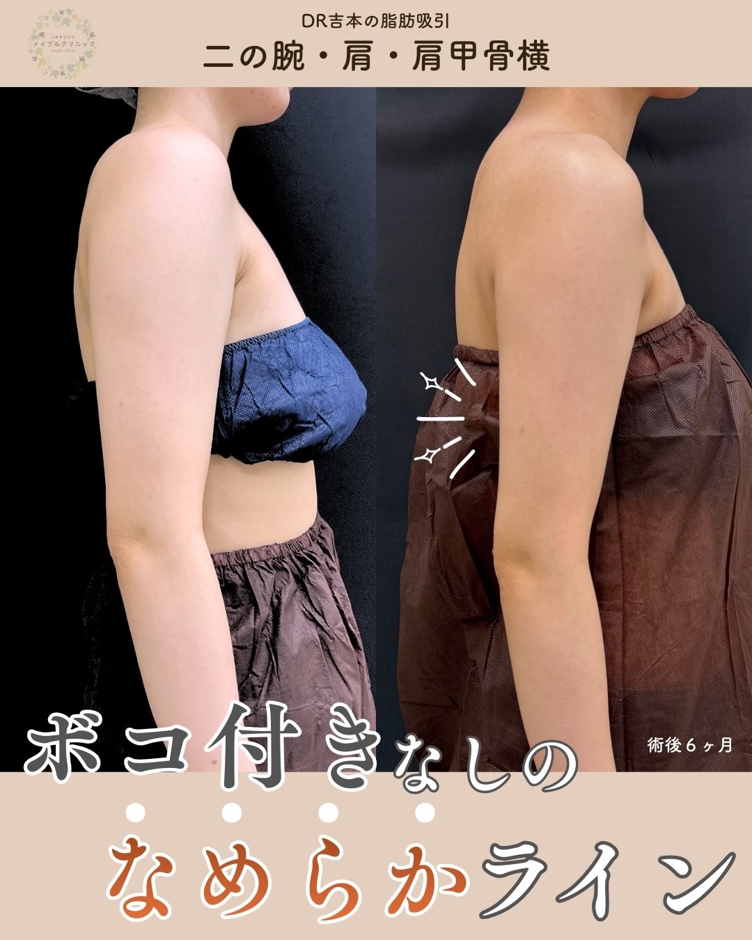 腕の脂肪吸引症例