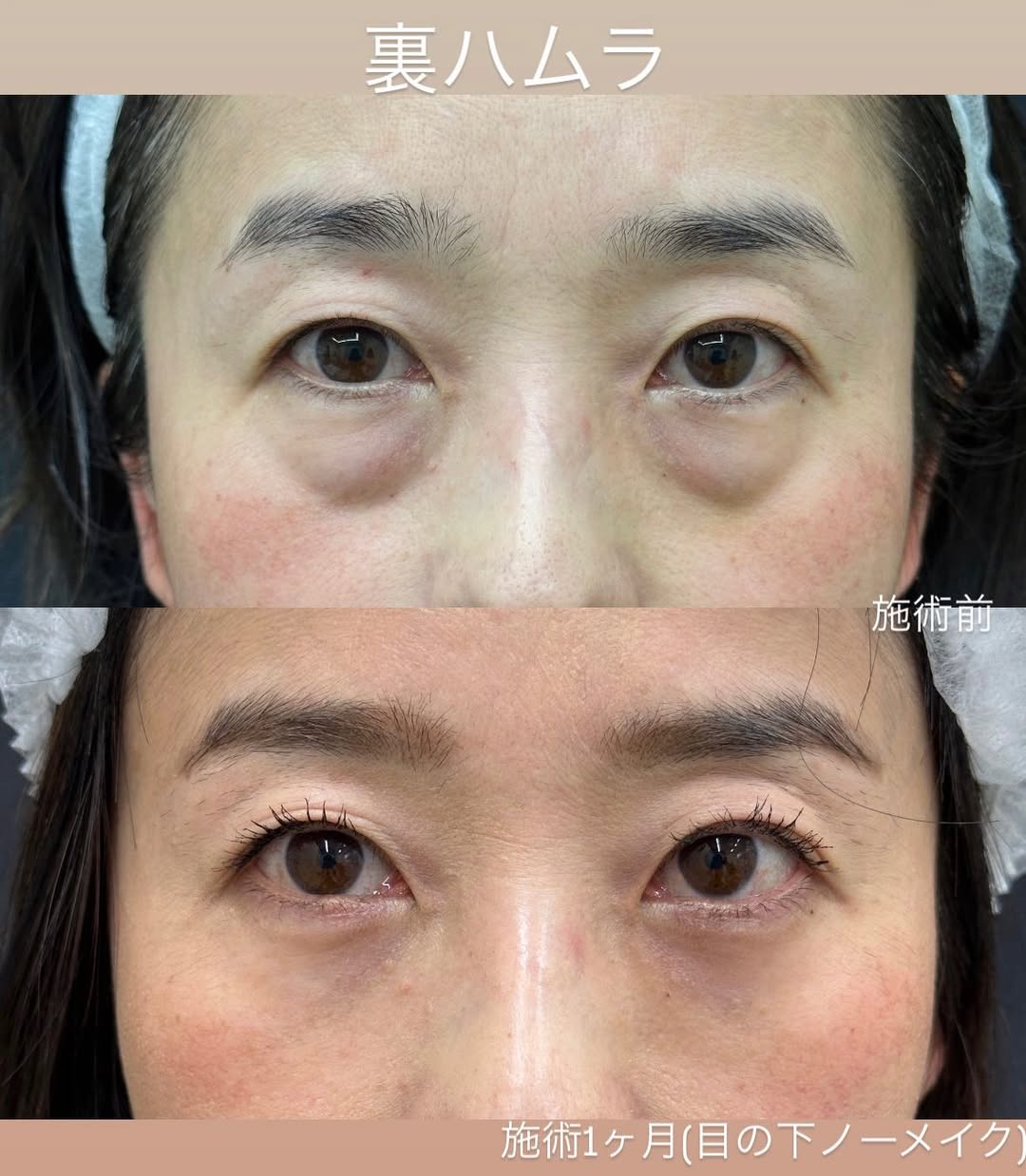 クマ取りで若返りのメイン画像