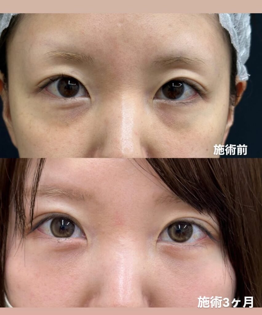 クマ取り＆二重整形