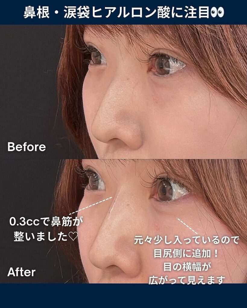 ヒアルロン酸注入症例