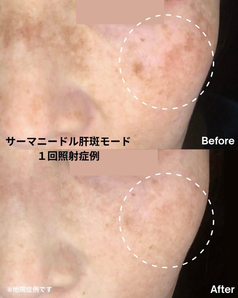 サーマニードル肝斑