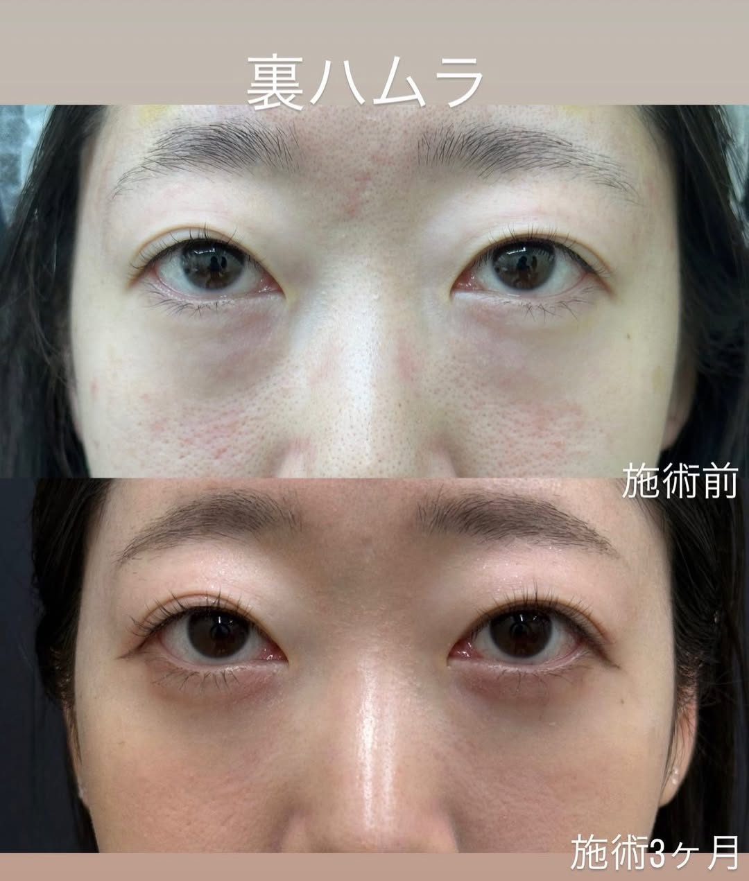 クマが取れて涙袋がはっきりのメイン画像