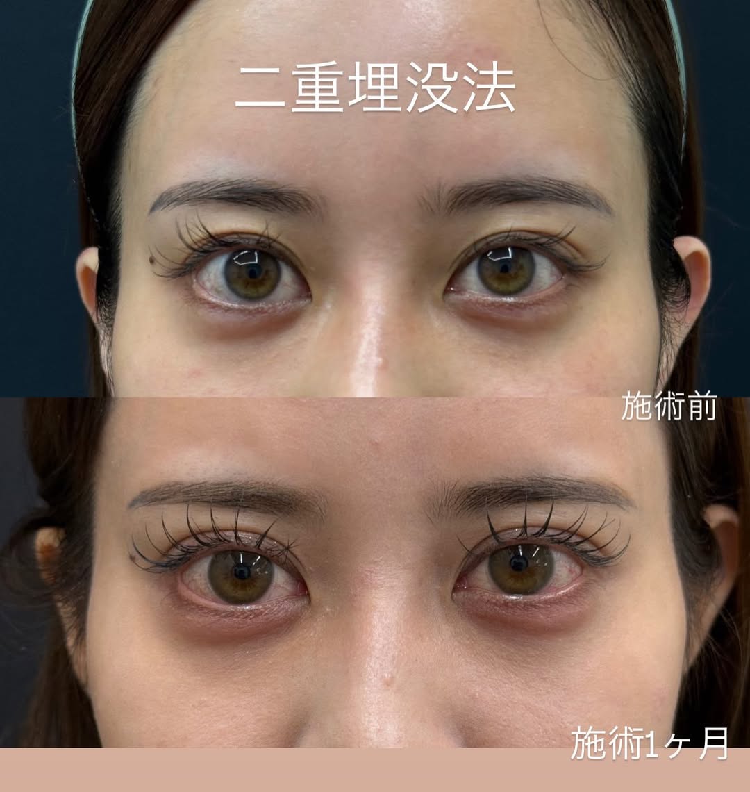 西洋の方のような二重にのメイン画像