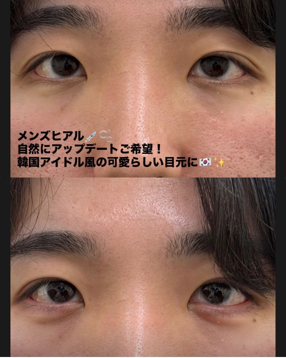 ヒアルロン酸注入