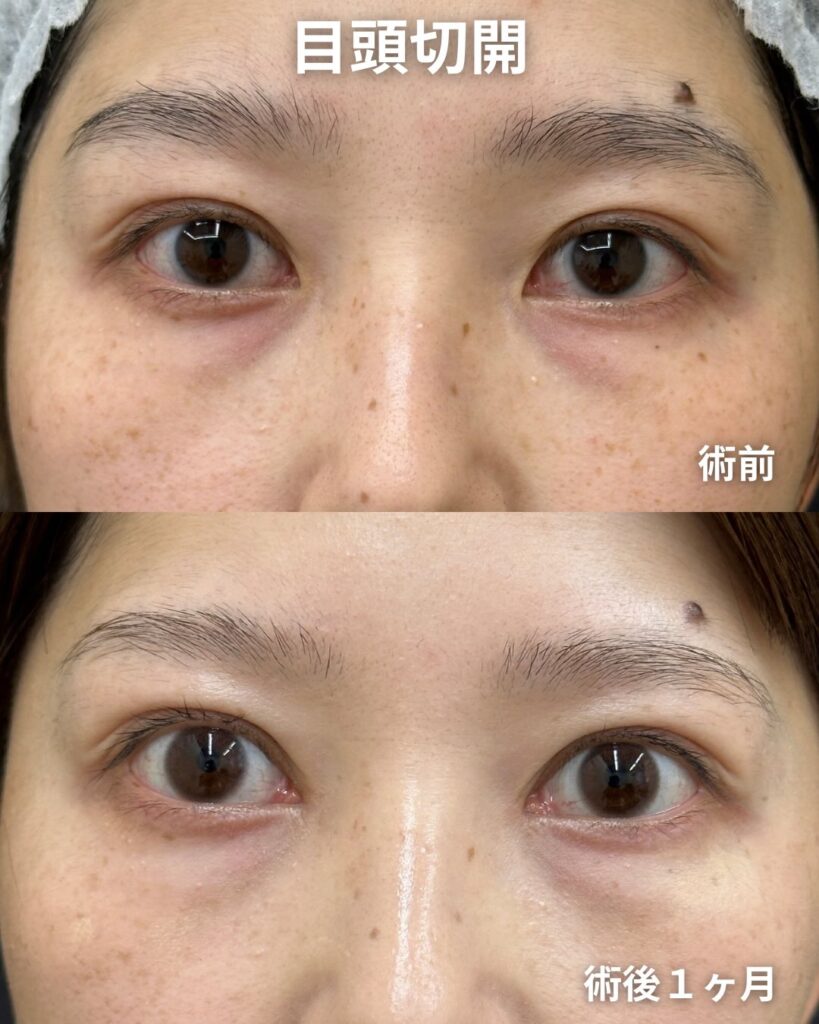 目頭切開症例