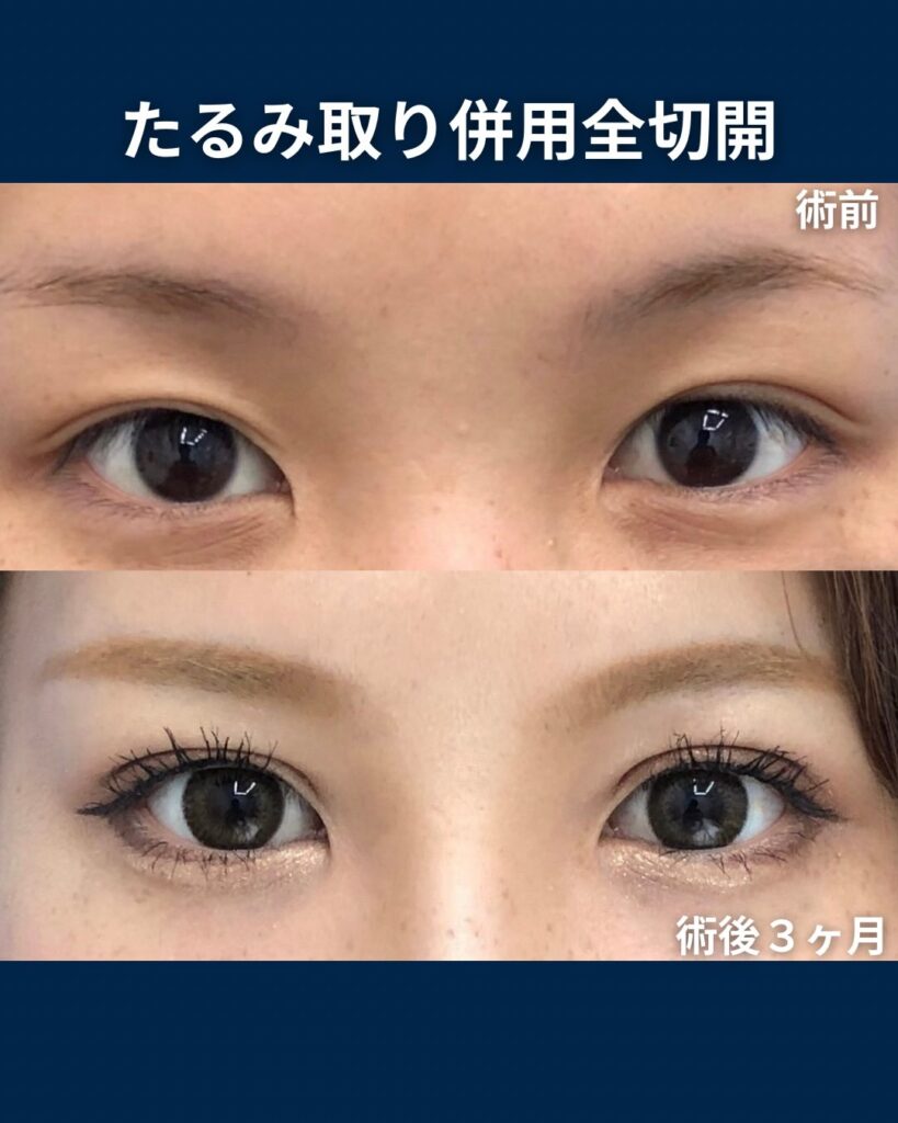 全切開二重整形