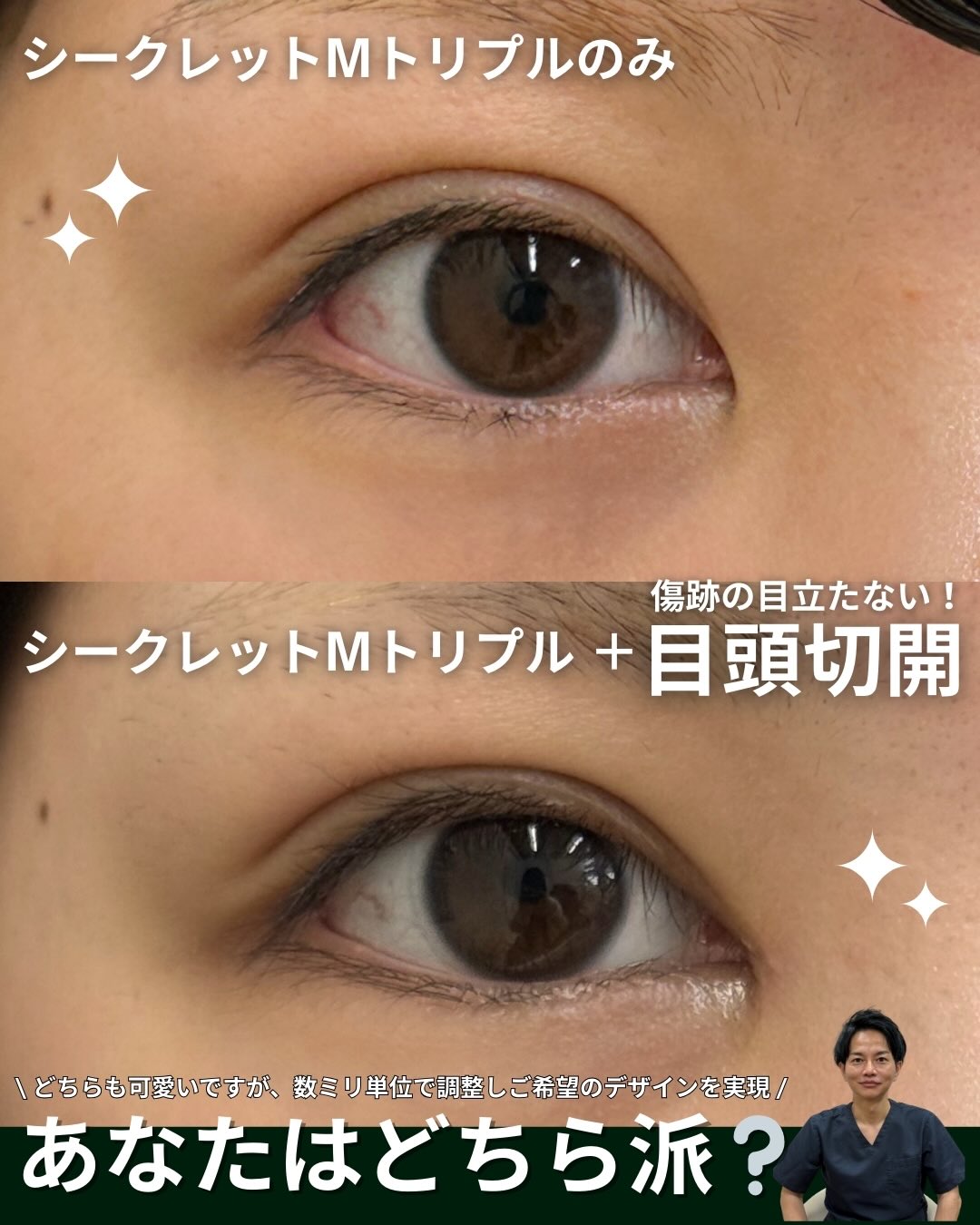 埋没法＋目頭切開のメイン画像