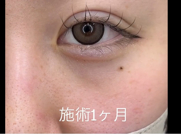 幅の広い瞼も埋没法でのメイン画像