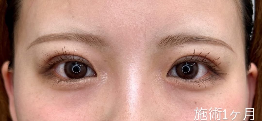 切らない二重整形（埋没法）施術1ヶ月の症例のメイン画像