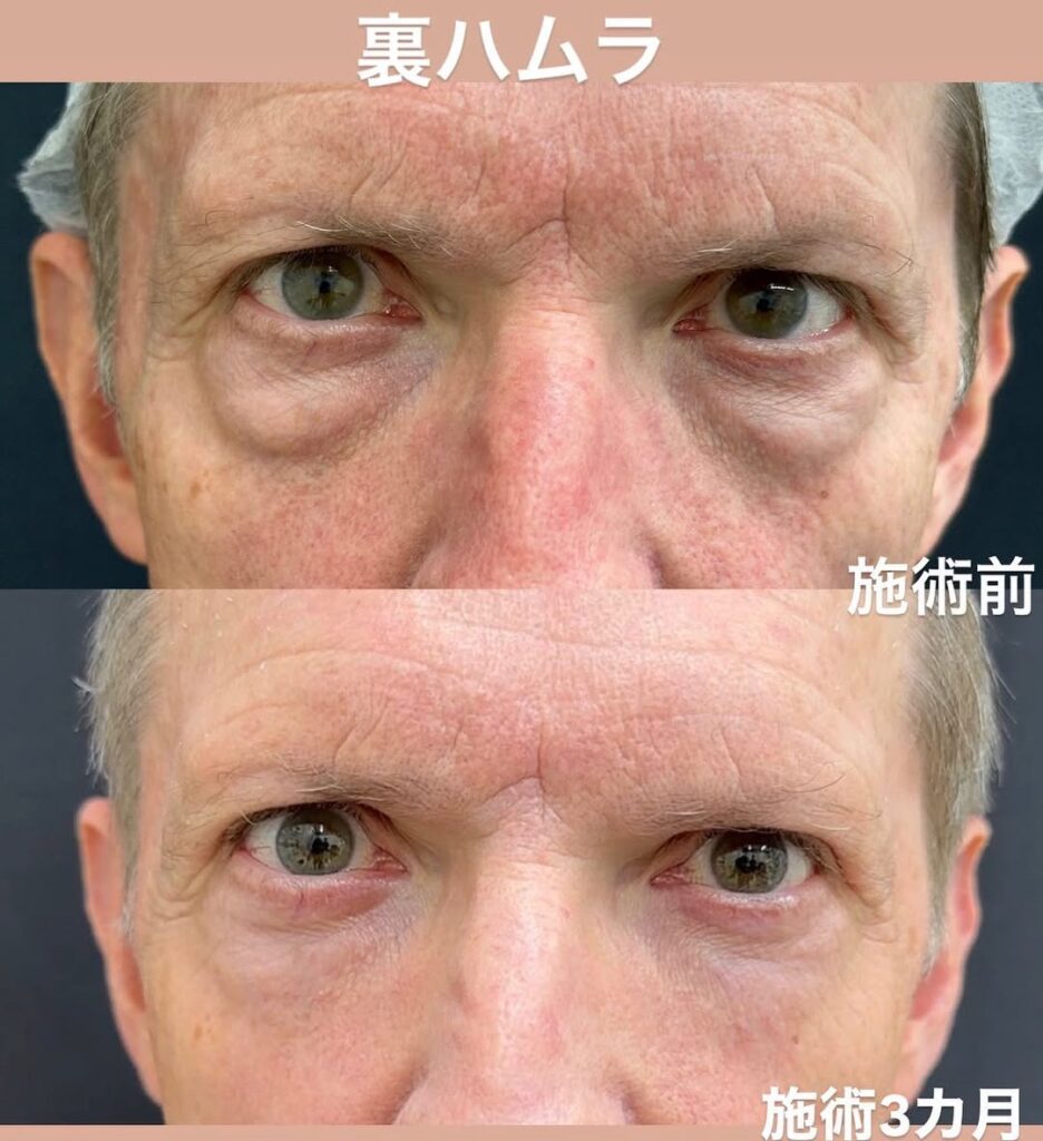 外国の方のクマ取り治療