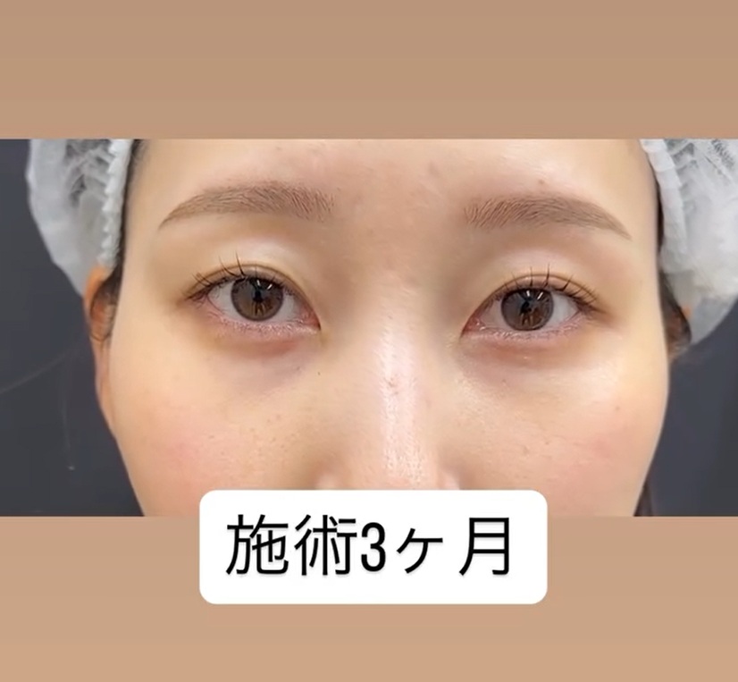 裏ハムラ法 -自然に若返るクマ取り治療-のメイン画像