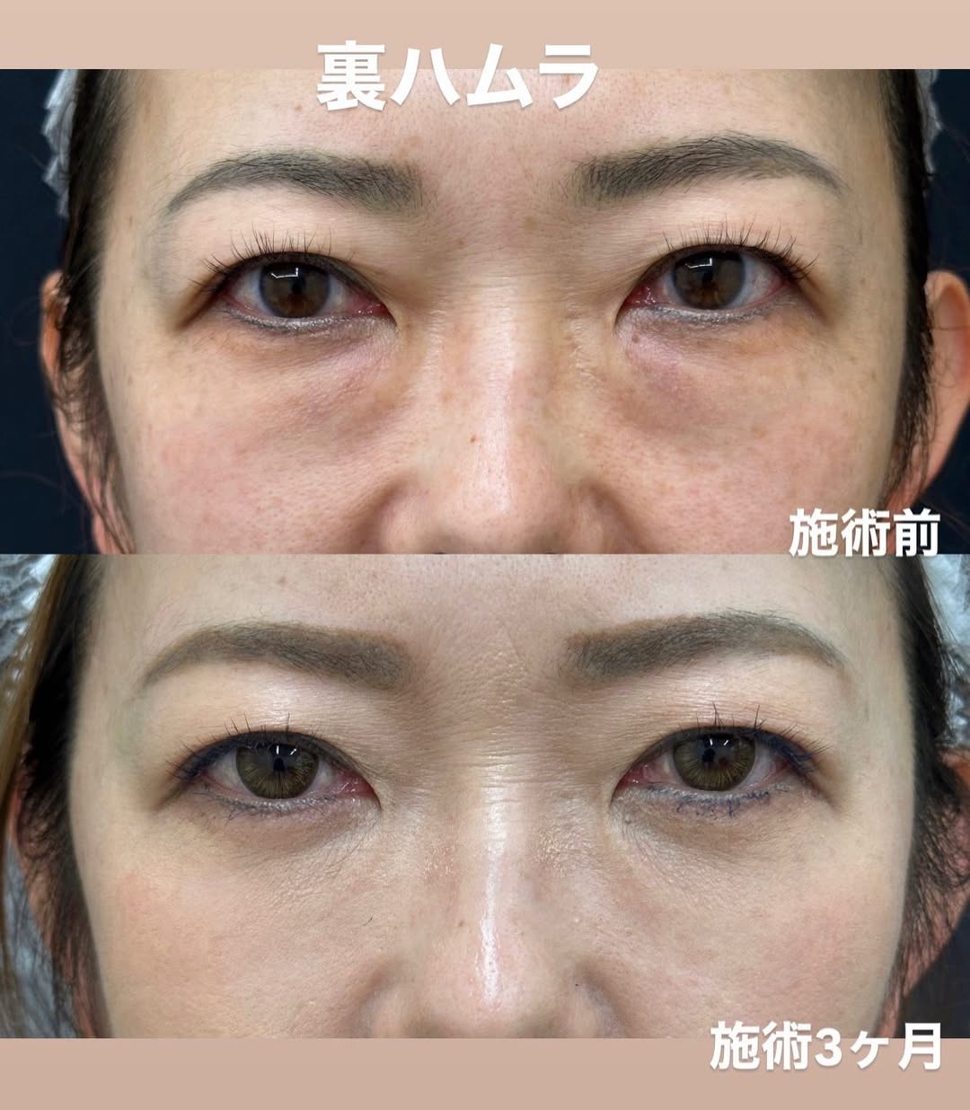 裏ハムラ法のクマ取り施術3ヶ月のメイン画像