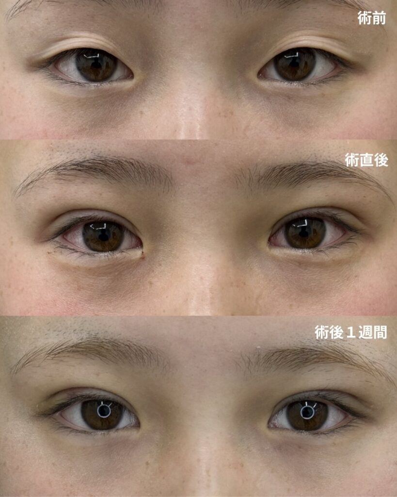 シークレットMトリプル