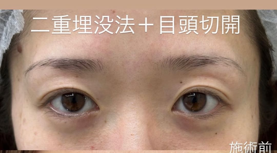 二重整形埋没法＋目頭切開の症例のメイン画像