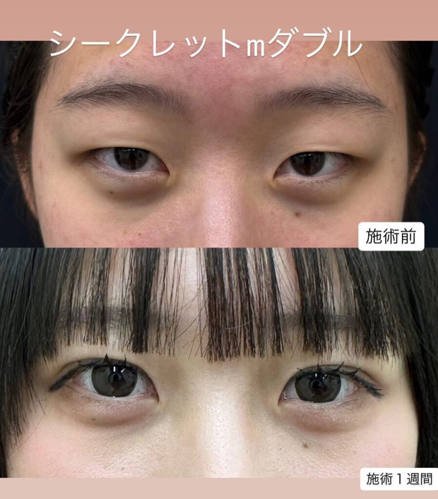 シークレットMダブル