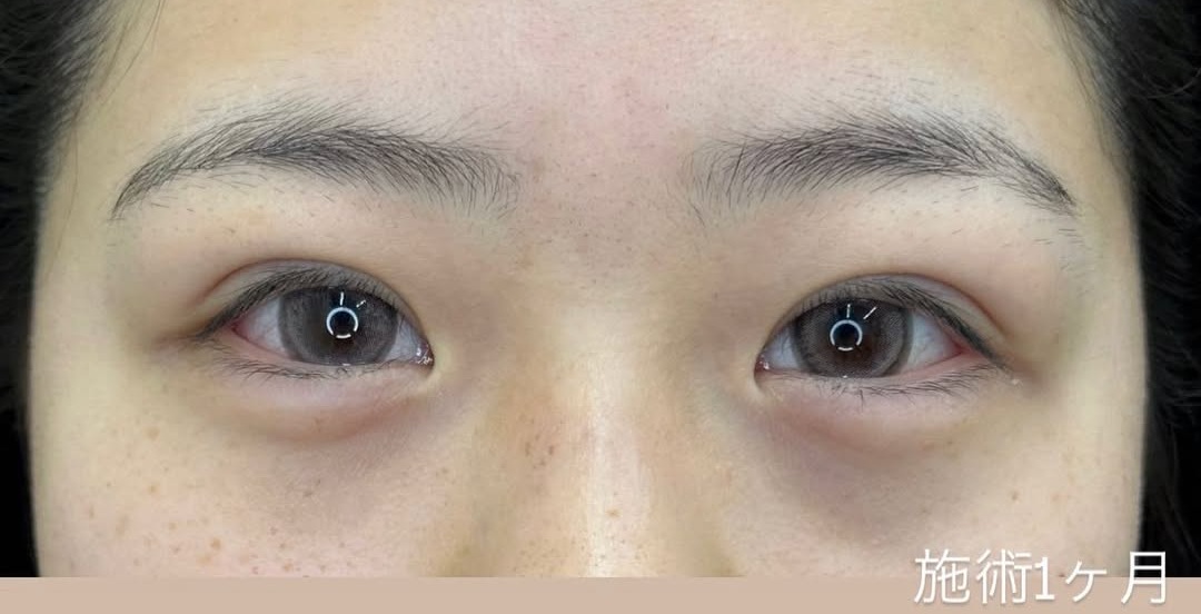 最高ランクの埋没法シークレットｍトリプルのメイン画像