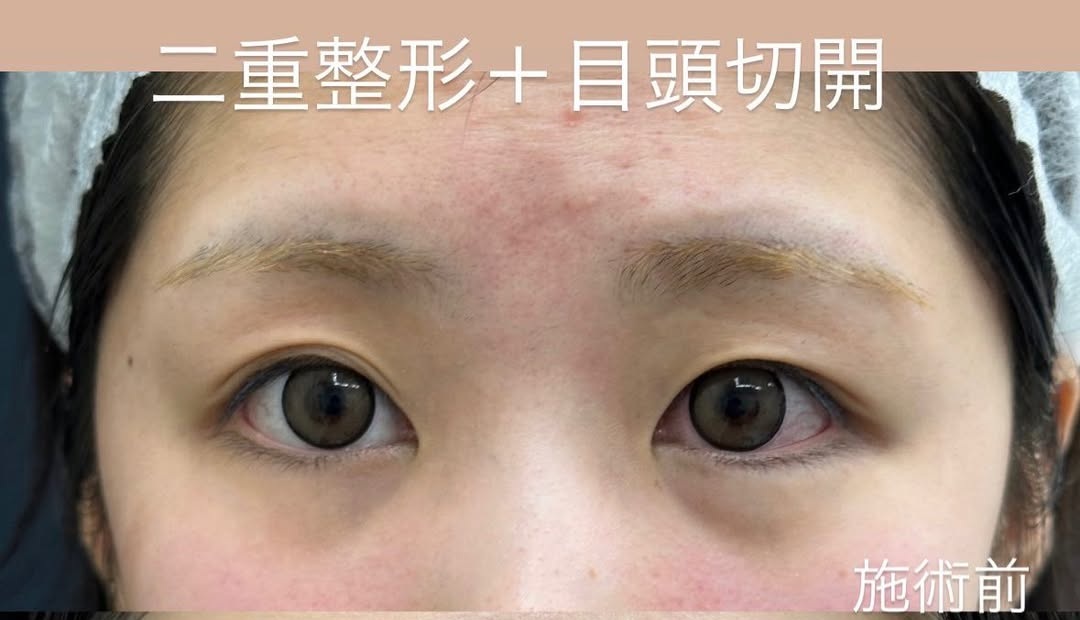 目元の美容整形の症例：二重埋没法と目頭切開のメイン画像