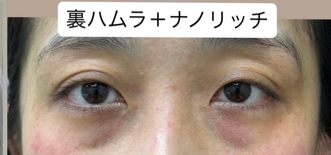 裏ハムラ法＋ナノリッチ(脂肪注入)の症例のメイン画像