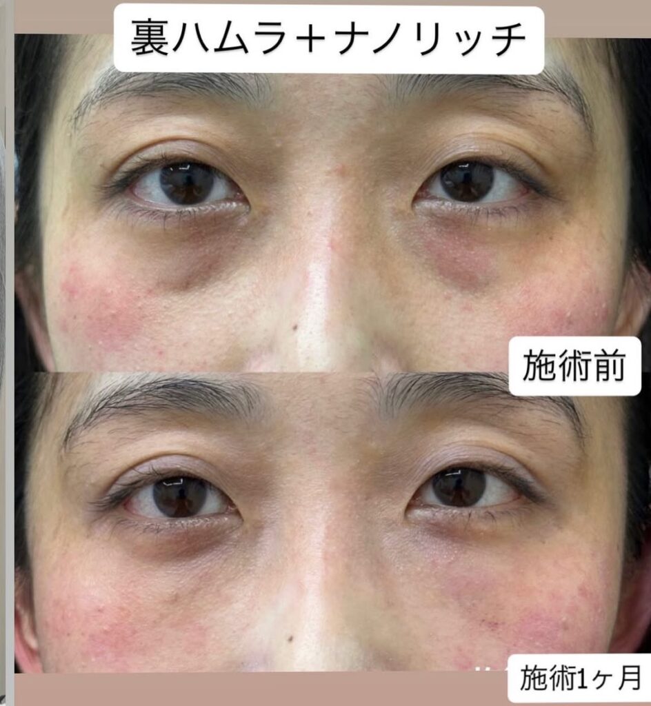 裏ハムラ法＋ナノリッチ