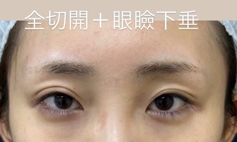 二重整形（切開法）＆眼瞼下垂治療の症例のメイン画像