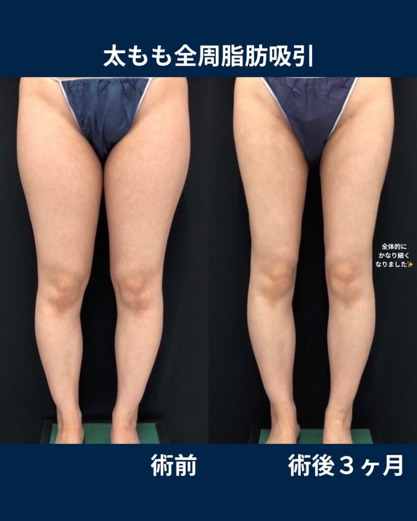 太もも脂肪吸引