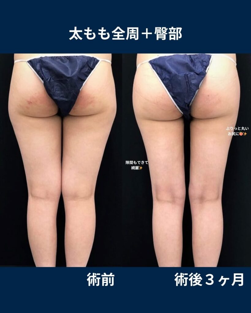 太もも＆臀部脂肪吸引