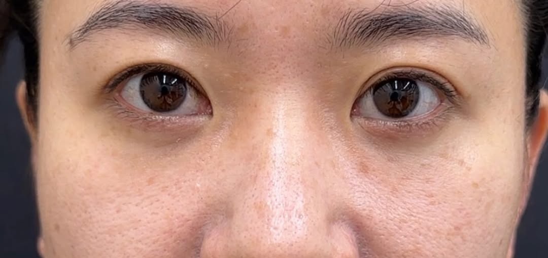 クマ取り治療で若返り！のメイン画像