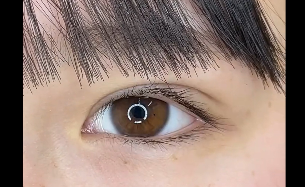 シークレットMトリプル症例 -二重整形埋没法-のメイン画像