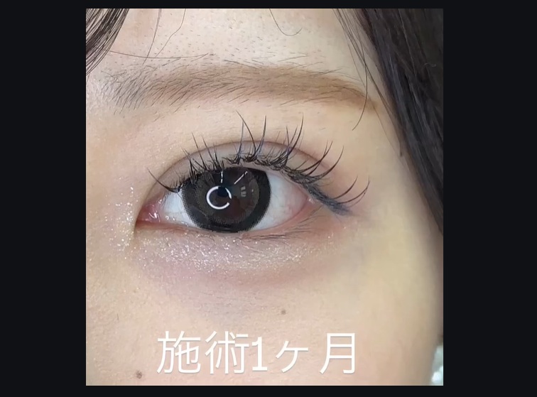 デザイン性の高い埋没法-シークレットＭトリプル-のメイン画像