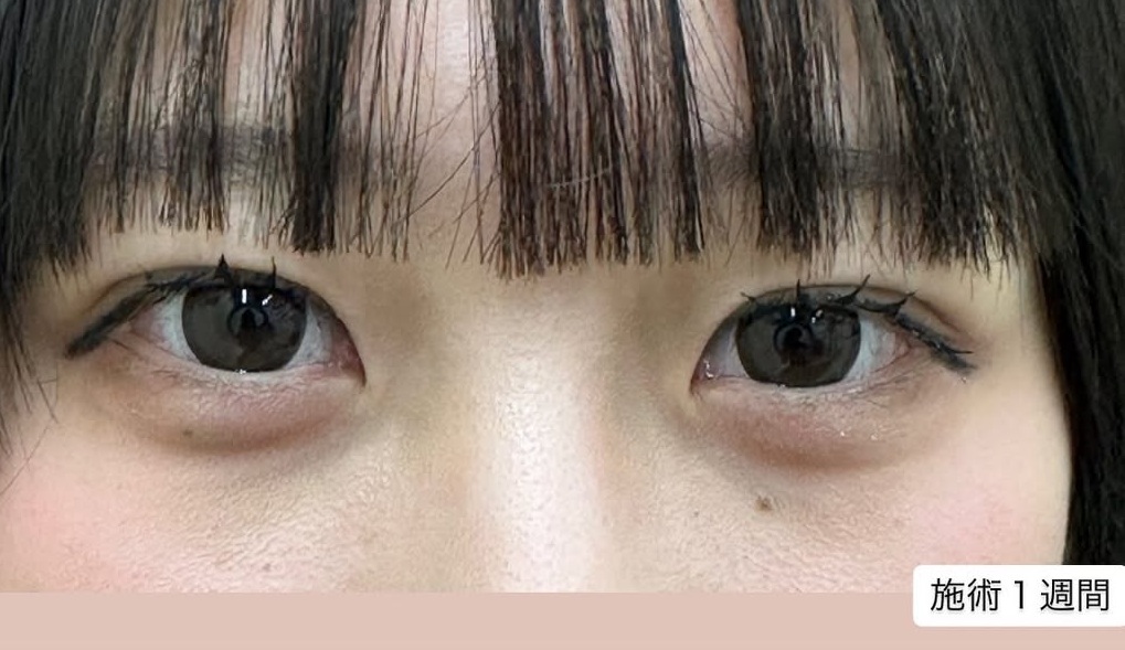 埋没法でやわらかい印象の目元にのメイン画像