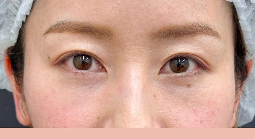 クマ取り治療裏ハムラ法で自然な仕上りにのメイン画像