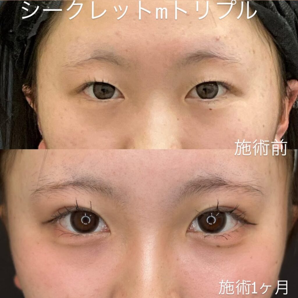 埋没法の症例