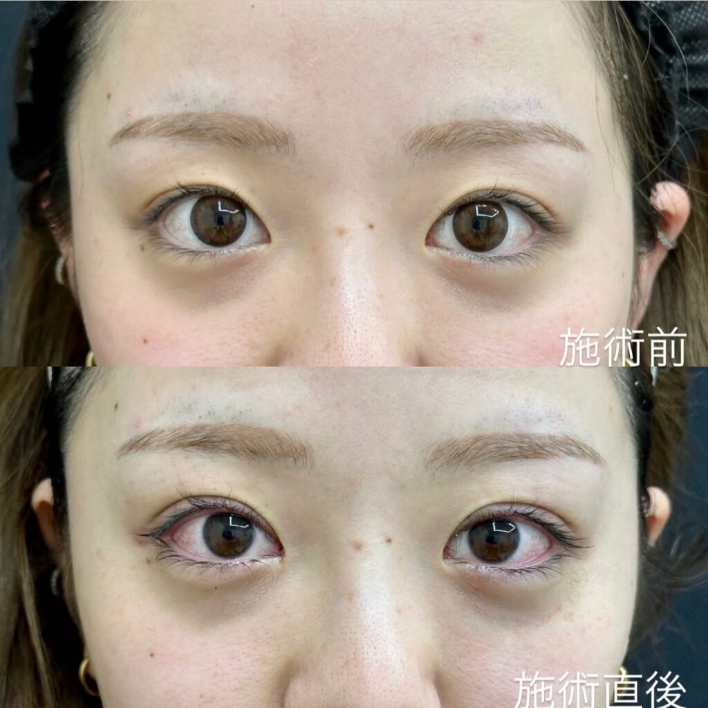 埋没法症例