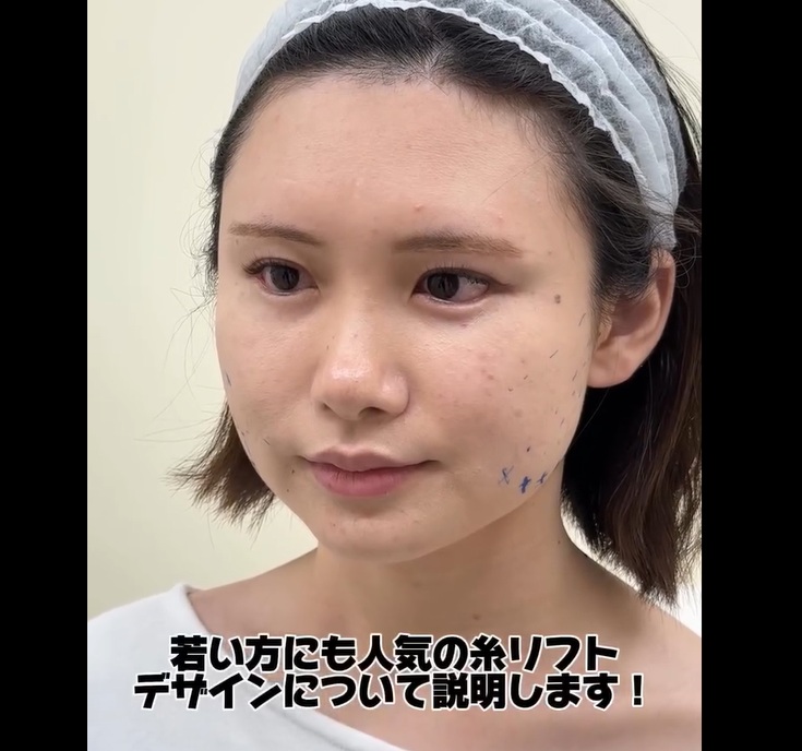 人気の糸リフトデザインについてのメイン画像